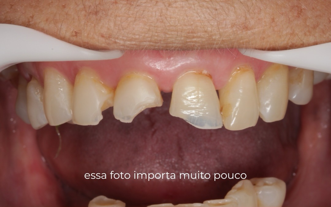 Antes e depois de reabilitação dos dentes anteriores
